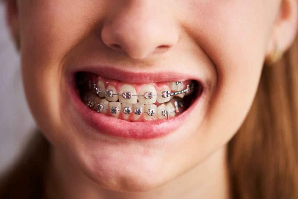 Braces in Lakeway, TX